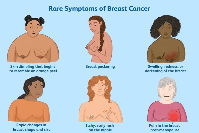 symptoms-of-breast-cancer