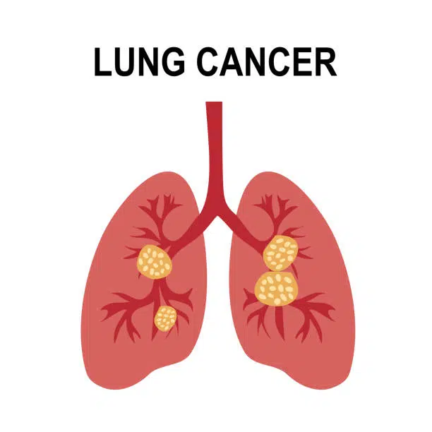 Lung-Cancer-Treatment