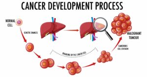 Kidney cancer