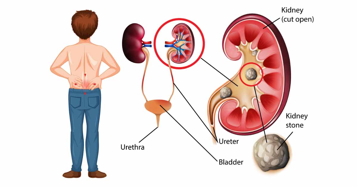 kidney Neoplasm