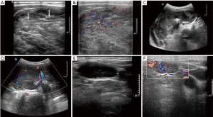 Anaplastic Thyroid Cancer and Lenvatinib
